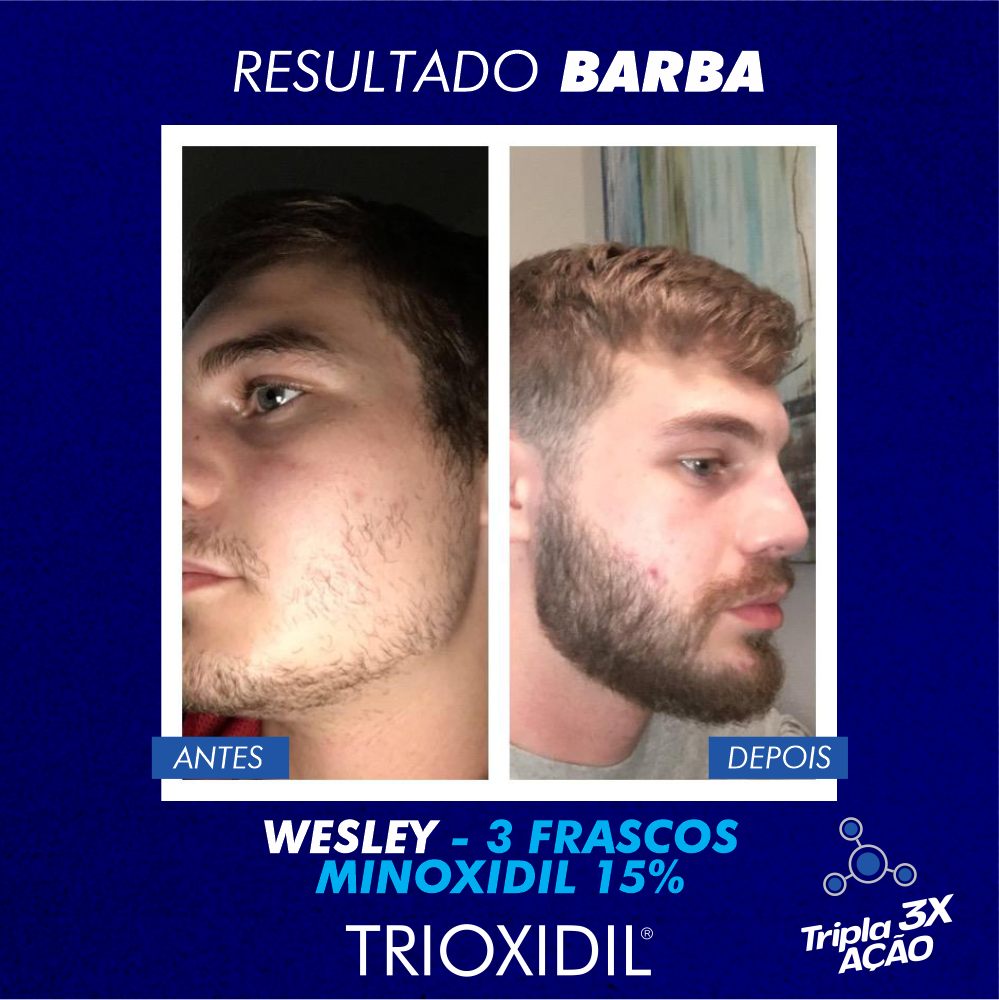trinoxidil serve para barba